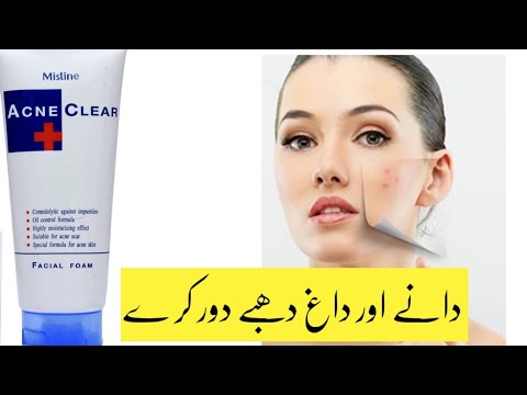 Mistine acne facial foam | best facewash for acne pimple