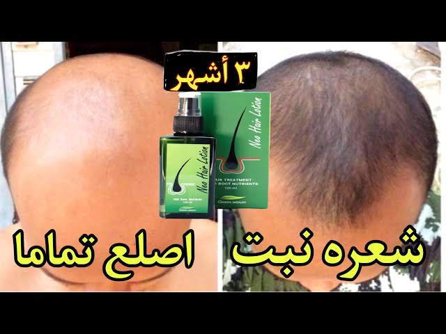 بخاخ نيو هير لإنبات الشعر+درما رول هدية