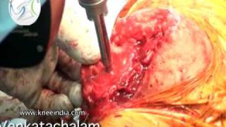 preview picture of video 'Journey BCS total knee replacement Part 2, Dr.Venkatachalam'