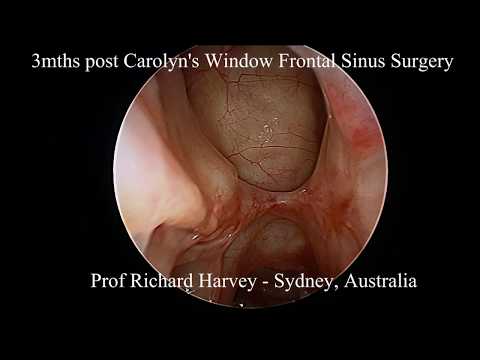 3mths postop Carolyn's Window frontal sinus recess surgery