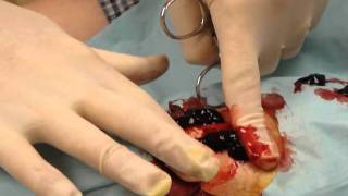 Knife Stabbing in Thigh Draining Blood Clot Evacuation - Kent Rilling