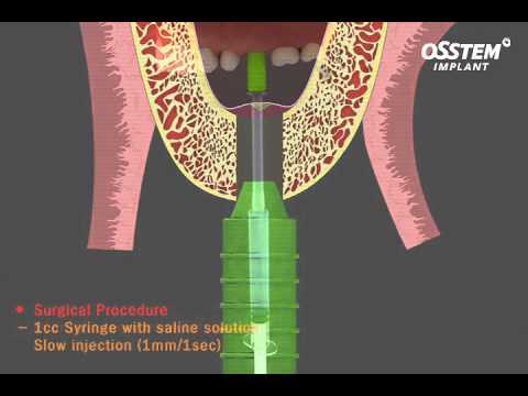 HIOSSEN OSSTEM CAS-KIT Crestal Approach - Sinus Kit