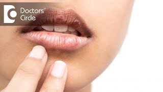 How to treat cracked corners of mouth? - Dr. Arundati Krishnaraj