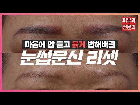 눈썹문신 망했다고요? 색깔이 변했다고요? 망한 반영구문신을 지워보자.