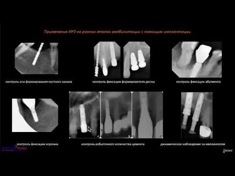 Рентгенологическое сопровождение дентальной имплантации
