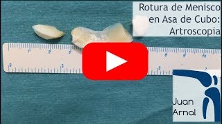 Rotura Menisco en Asa de Cubo: Cirugía (Artroscopia)