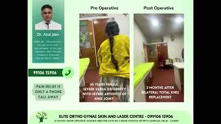 Fast recovery in Total knee replacement -results टेढ़े घुटने को कैसे मिला आराम