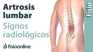 Artrosis lumbar - Signos radiológicos