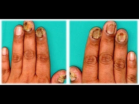 Kung paano mapupuksa ng amag sa pader ng remedyong bahay folk Fungus dahilan upang nail paa
