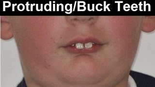 What Causes Protruded Teeth, Buck Teeth, Frontal Teeth Tipping Forward by Dr Mike Mew
