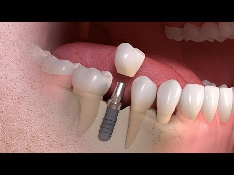 Schmerzen in den Muskeln der Beine und Rücken Kohlblatt mit Gelenkentzündung