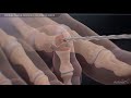 Minimally Invasive Hammertoe Deformity Correction