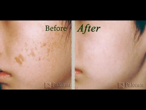 Maschera da prezzemolo per la persona che candeggia Il tsa un peeling da pigmentary nota su