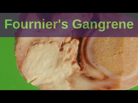 What is Fournier's Gangrene? - Pathology mini tutorial