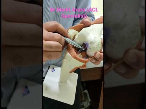 What happens once I have an ACL Tear or Injury? Dr Manit Arora