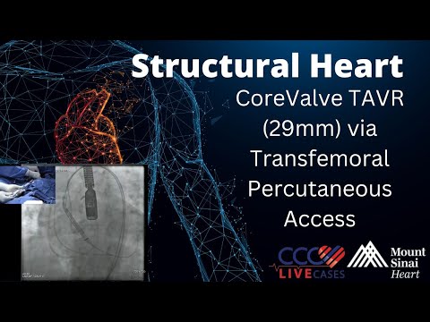 CoreValve TAVR (29mm) via Transfemoral Percutaneous Access - February 2015 Structural Live Case