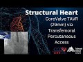 CoreValve TAVR 29mm Via Transfemoral Percutaneous Access February 2015 Structural Live Case