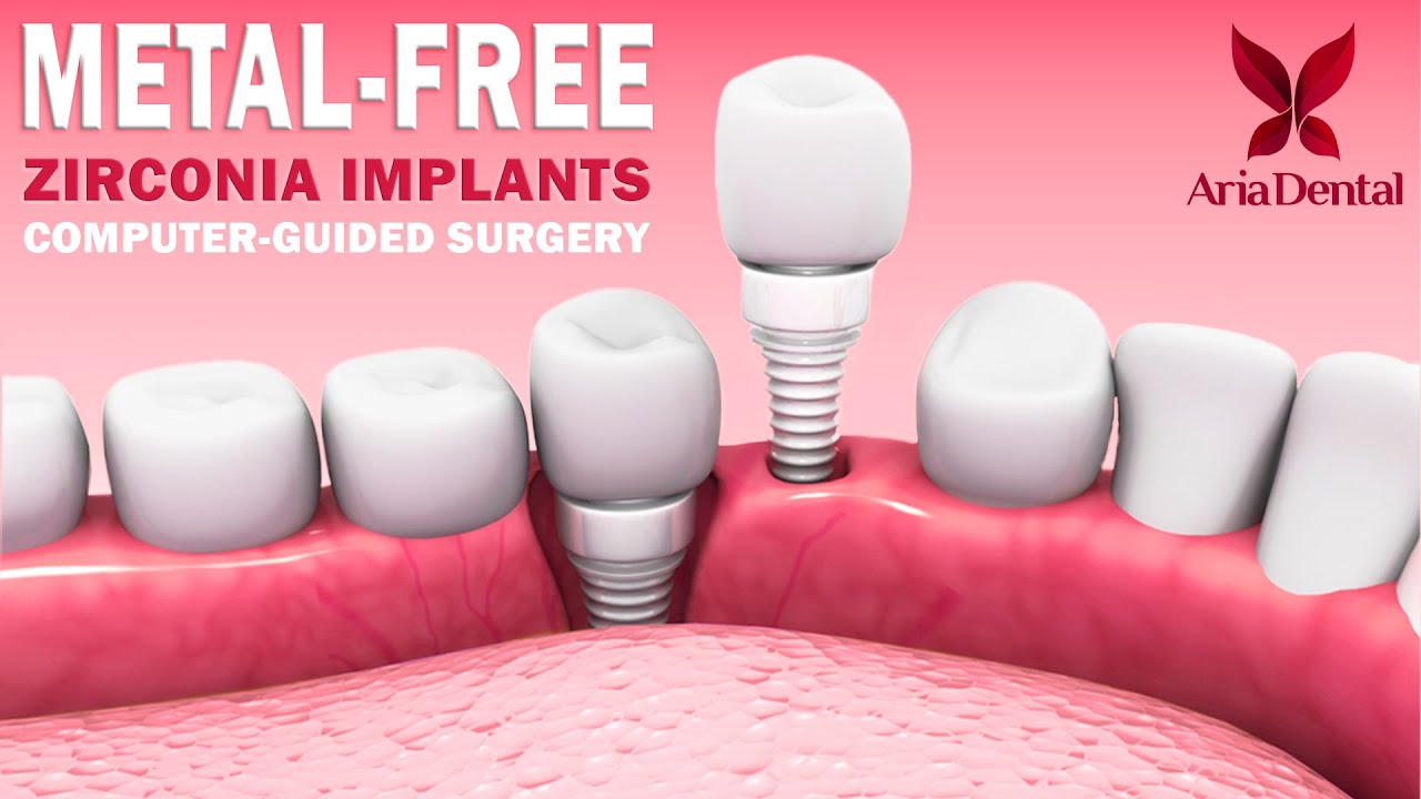 METAL-FREE ZIRCONIA IMPLANTS