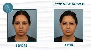 Restylane Lyft (Perlane) filler for cheek lifting and facial balancing