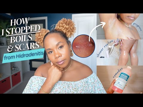 How I STOPPED HS Boils & Scars in Armpits & Thighs | TMI Hygiene, Shower Routine, Diet + MORE