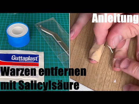 Warzen entfernen mit Salicylsäure (Guttaplast Warzen Pflaster, Schwielen, Hühneraugen) Anleitung