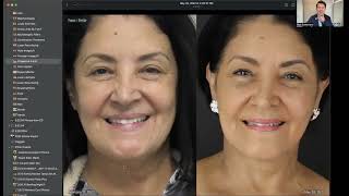 The Ultimate Guide to Fitzpatrick 4, 5, & 6: Facelift and Filler Transformations!