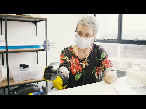 Bionic hand for COVID survivor who lost all limbs