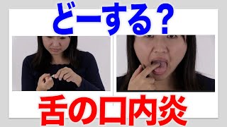 つらい舌の口内炎にはこの方法！