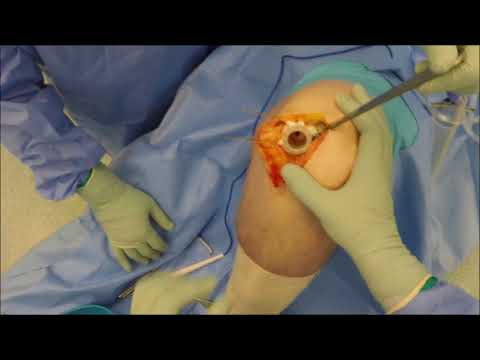 Surgical Technique - Episurf Medical
