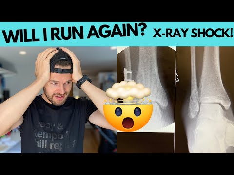 BACK TO THE HOSPITAL AFTER ANKLE SURGERY.. WILL THEY LET ME RUN AGAIN?