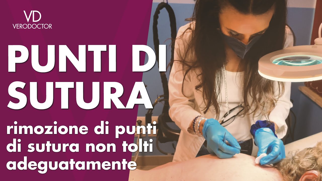 PUNTI DI SUTURA rimozione punti di sutura non rimossi adeguatamente - VERODOCTOR