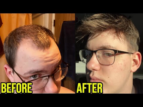 LOSING HAIR AND ENDED UP GETTING A HAIR SYSTEM AT 19 YEARS OLD...