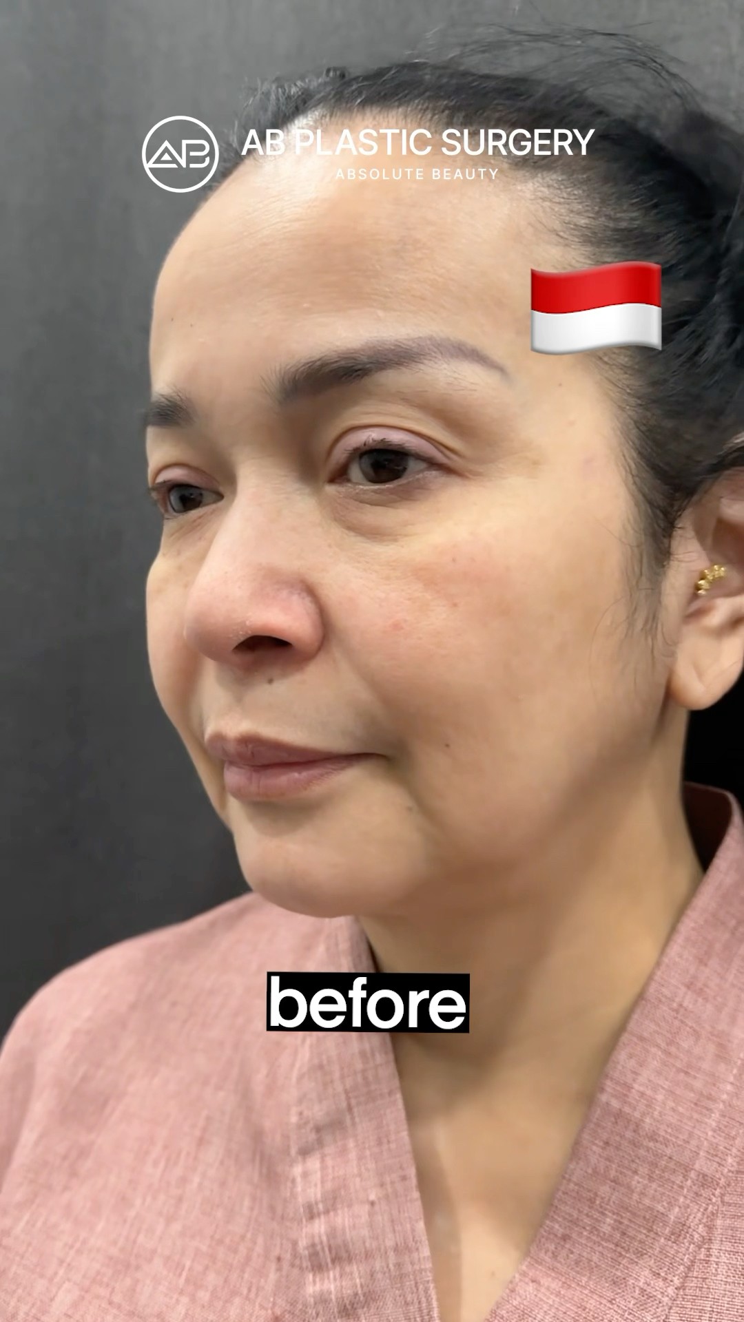 Only 7 Days after Facelift Korea