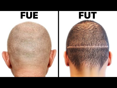 FUE vs. FUT Hair Transplant Harvesting