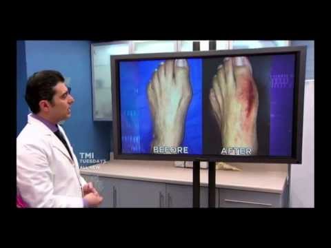 Unbelievable Bunion Cure: The Doctor's TV Show Couldn't Believe Their Eyes!