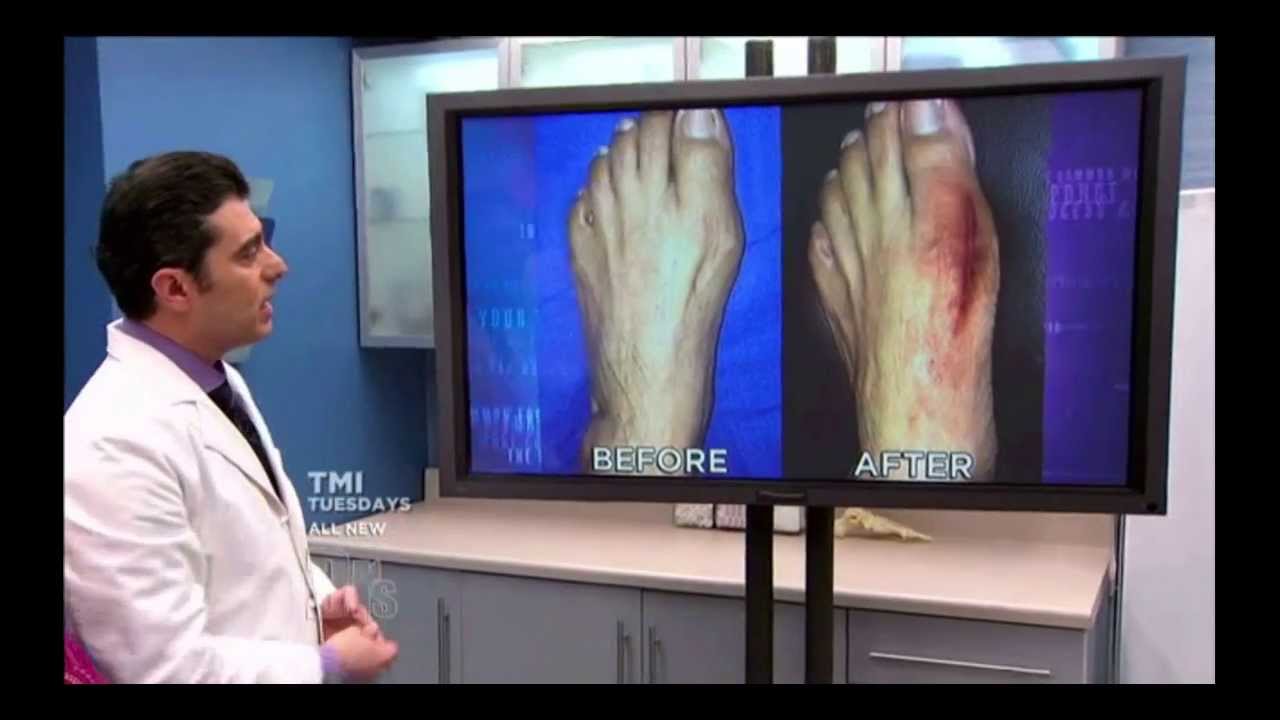 Unbelievable Bunion Cure: The Doctor's TV Show Couldn't Believe Their Eyes!