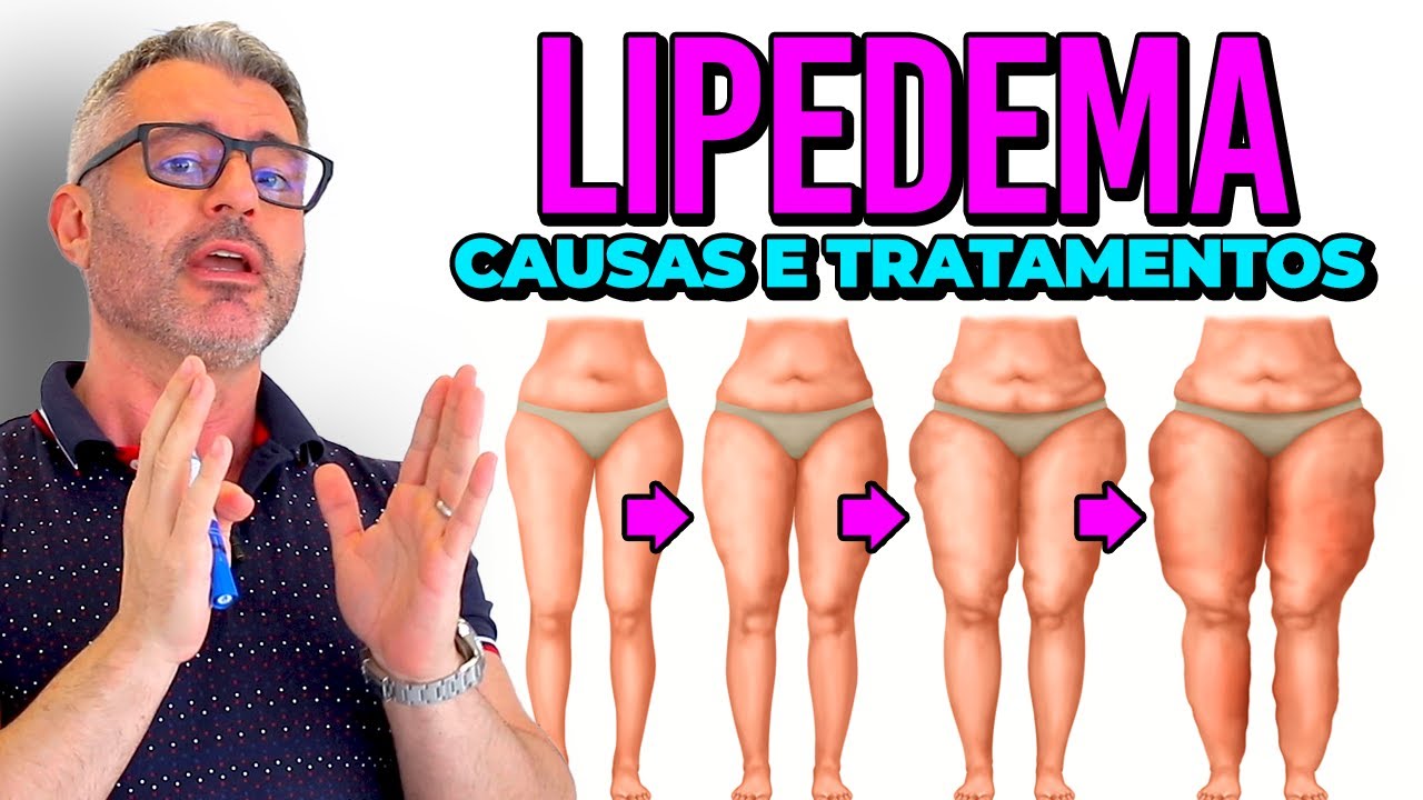 COMO TRATAR LIPEDEMA? ➡️🦵🏽