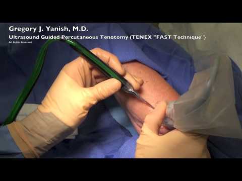 Ultrasound Guided Percutaneous Tenotomy 