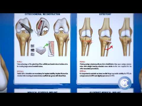 Cause di risposta del dolore Sintomi di osteoartrite delle articolazioni dellanca