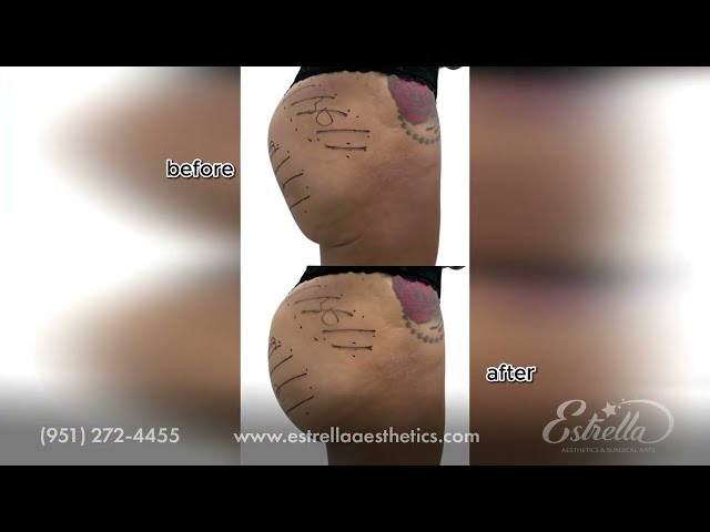 BBL Injections – Bella Butt, Top Corona Med Spa in California