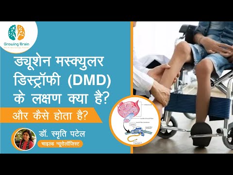 डीएमडी (DMD) के लक्षण क्या है और कैसे होता है? | जानिए हमारे चाइल्ड न्यूरोलॉजिस्ट डॉ स्मृति पटेल से