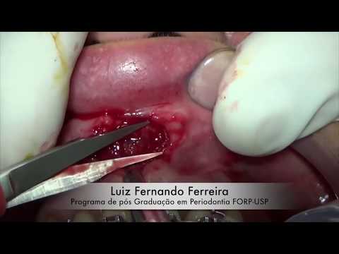 Labial Frenectomy Procedure