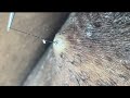 HS INGROWN HAIR REMOVAL TANGLED EXTRACTION Ep 12