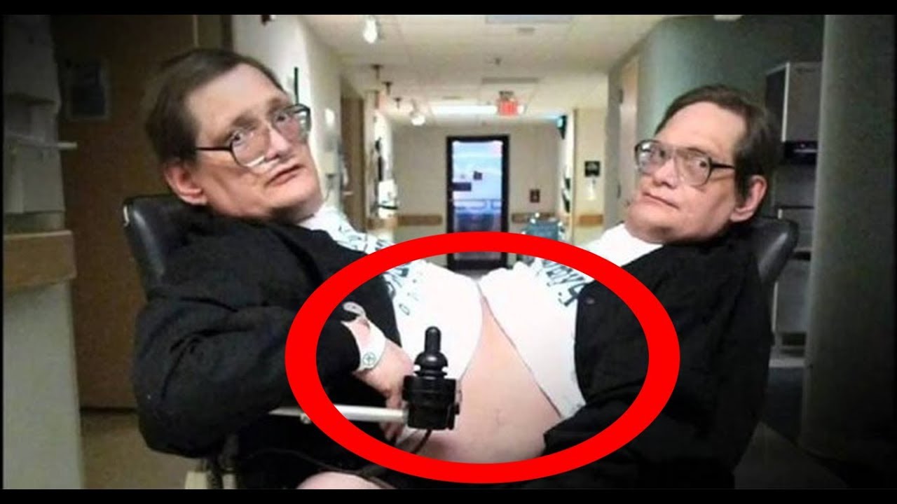 🔴 Os Casos Médicos mais Incríveis do Mundo! Irmãos Siameses!