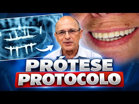Prótese fixa total (Protocolo) sobre implantes em quem tem pouco osso e muita gengiva. Dr. Antônio 
