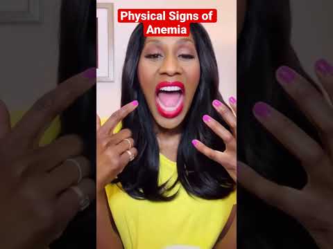 Physical Signs of Anemia🩸! A Doctor Explains #shorts