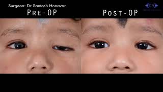 Ptosis Correction with Tarsofrontal Sling Using Ethibond Suture