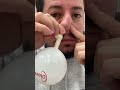 Otovent Glue Ear Treatment