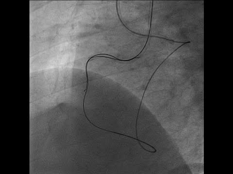 PCI for CTO part -3 retrograde