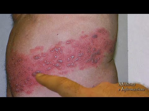 Come trattare in modo efficace collo basso il mal di schiena Sintomi trattamento per la schiena ammaccate